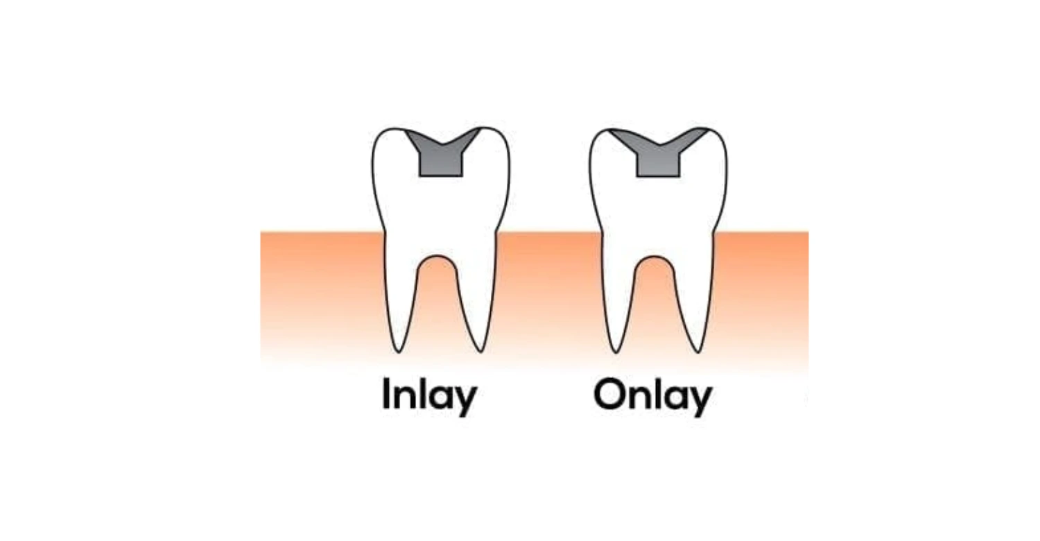 Inlay Onlay Fillings 2